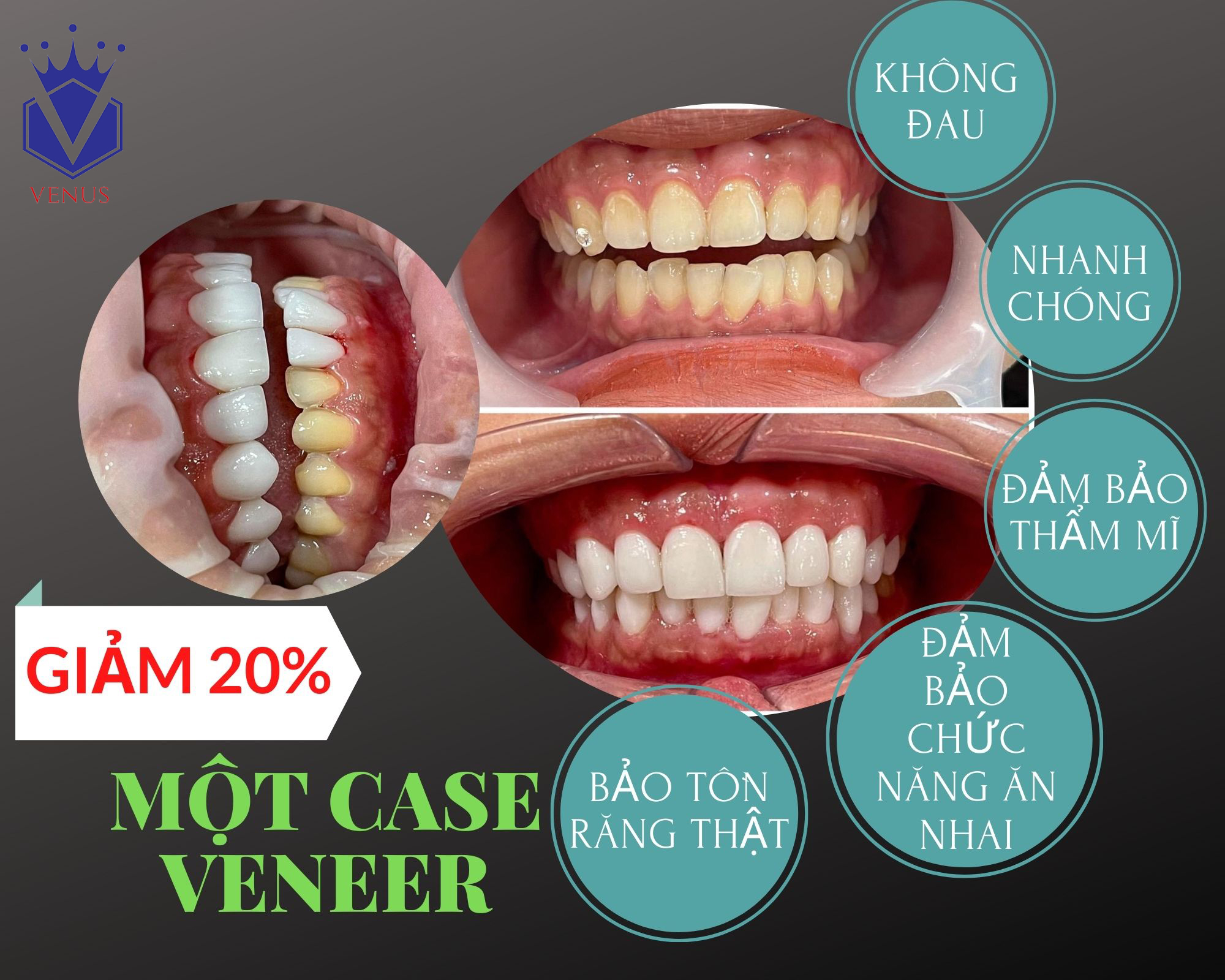 VENEER LÀ GÌ? NHỮNG ĐIỀU CẦN BIẾT VỀ VENEER.